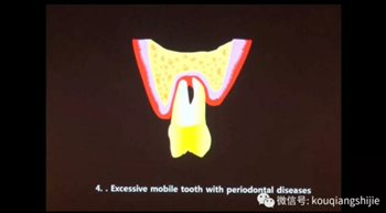 拔牙窩的處理-新思路 拔牙窩的處理-新思路