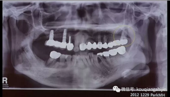 拔牙窩的處理-新思路 拔牙窩的處理-新思路