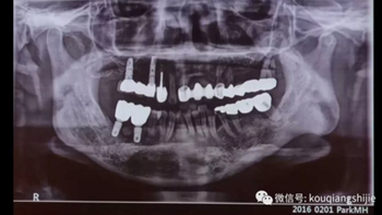 拔牙窩的處理-新思路 拔牙窩的處理-新思路
