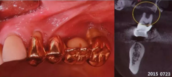 拔牙窩的處理-新思路 拔牙窩的處理-新思路