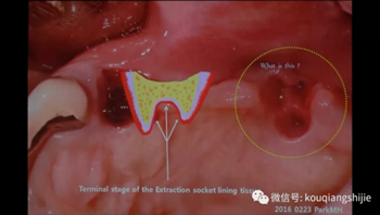 拔牙窩的處理-新思路 拔牙窩的處理-新思路