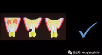 拔牙窩的處理-新思路 拔牙窩的處理-新思路