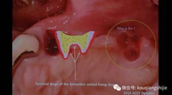 拔牙窩的處理-新思路 拔牙窩的處理-新思路