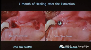 拔牙窩的處理-新思路 拔牙窩的處理-新思路