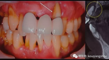 拔牙窩的處理-新思路 拔牙窩的處理-新思路