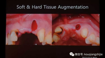 拔牙窩的處理-新思路 拔牙窩的處理-新思路