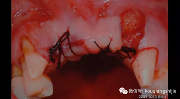 拔牙窩的處理-新思路 拔牙窩的處理-新思路