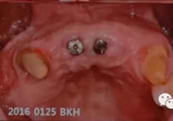 拔牙窩的處理-新思路 拔牙窩的處理-新思路