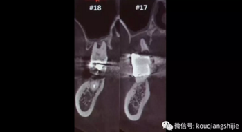 拔牙窩的處理-新思路 拔牙窩的處理-新思路