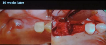 拔牙窩的處理-新思路 拔牙窩的處理-新思路