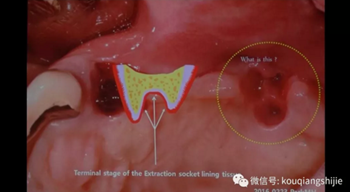 拔牙窩的處理-新思路 拔牙窩的處理-新思路