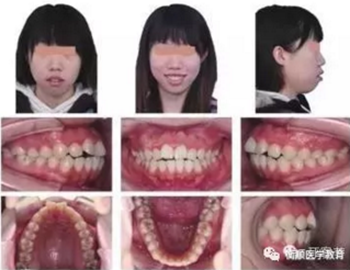 病例精選 | 骨性Ⅱ類高角面型矯治病例 病例精選 | 骨性Ⅱ類高角面型矯治病例