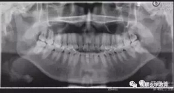 病例精選 | 骨性Ⅱ類高角面型矯治病例 病例精選 | 骨性Ⅱ類高角面型矯治病例