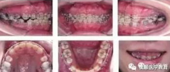 病例精選 | 骨性Ⅱ類高角面型矯治病例 病例精選 | 骨性Ⅱ類高角面型矯治病例