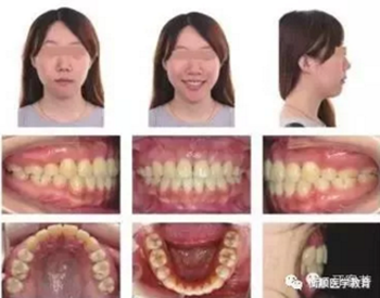 病例精選 | 骨性Ⅱ類高角面型矯治病例 病例精選 | 骨性Ⅱ類高角面型矯治病例