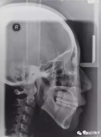 病例精選 | 骨性Ⅱ類高角面型矯治病例 病例精選 | 骨性Ⅱ類高角面型矯治病例