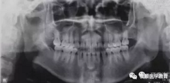 病例精選 | 骨性Ⅱ類高角面型矯治病例 病例精選 | 骨性Ⅱ類高角面型矯治病例