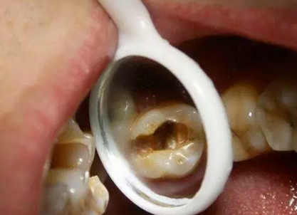 牙髓癥狀的鑒別 牙髓癥狀的鑒別