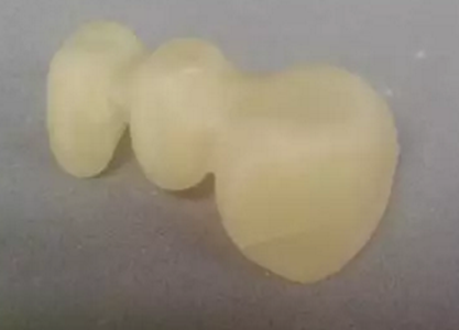 全鋯牙冠裂原因分析&mdash;操作流程工藝以及患者日常使用