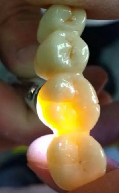 全鋯牙冠裂原因分析&mdash;操作流程工藝以及患者日常使用