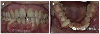 正畸文獻(xiàn)閱讀--正畸保持手段的流行病學(xué)研究 正畸文獻(xiàn)閱讀--正畸保持手段的流行病學(xué)研究