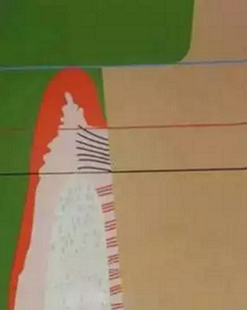 雙線排齦在口腔臨床冠修復(fù)上的應(yīng)用 雙線排齦在口腔臨床冠修復(fù)上的應(yīng)用