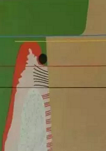 雙線排齦在口腔臨床冠修復(fù)上的應(yīng)用 雙線排齦在口腔臨床冠修復(fù)上的應(yīng)用