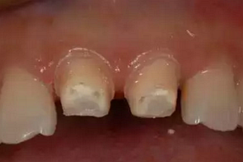 雙線排齦在口腔臨床冠修復(fù)上的應(yīng)用 雙線排齦在口腔臨床冠修復(fù)上的應(yīng)用