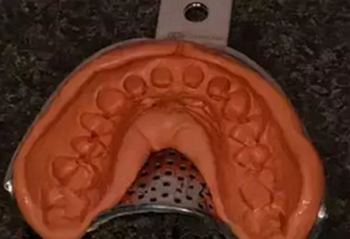 雙線排齦在口腔臨床冠修復(fù)上的應(yīng)用 雙線排齦在口腔臨床冠修復(fù)上的應(yīng)用