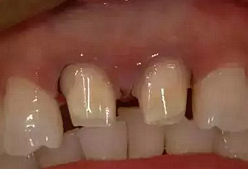 雙線排齦在口腔臨床冠修復(fù)上的應(yīng)用 雙線排齦在口腔臨床冠修復(fù)上的應(yīng)用