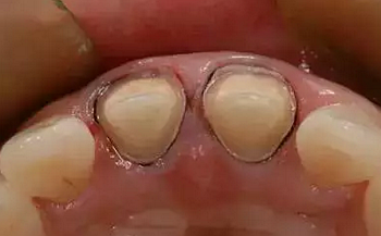 雙線排齦在口腔臨床冠修復(fù)上的應(yīng)用 雙線排齦在口腔臨床冠修復(fù)上的應(yīng)用