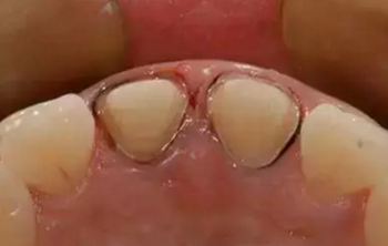 雙線排齦在口腔臨床冠修復(fù)上的應(yīng)用 雙線排齦在口腔臨床冠修復(fù)上的應(yīng)用