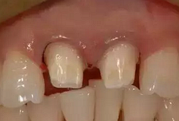 雙線排齦在口腔臨床冠修復(fù)上的應(yīng)用 雙線排齦在口腔臨床冠修復(fù)上的應(yīng)用