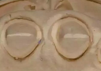 雙線排齦在口腔臨床冠修復(fù)上的應(yīng)用 雙線排齦在口腔臨床冠修復(fù)上的應(yīng)用