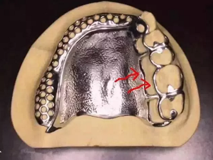 活動義齒修復(fù)，要懂的鋼托設(shè)計