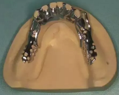 活動義齒修復(fù)，要懂的鋼托設(shè)計