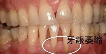 最可怕的牙病&mdash;&mdash;牙齦萎縮