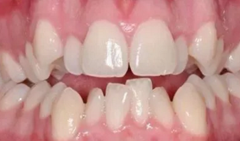 最可怕的牙病&mdash;&mdash;牙齦萎縮