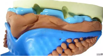 【分享】高水平義齒制作工藝流程 【分享】高水平義齒制作工藝流程