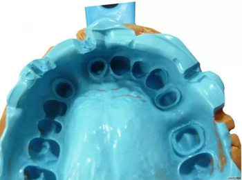 【分享】高水平義齒制作工藝流程 【分享】高水平義齒制作工藝流程