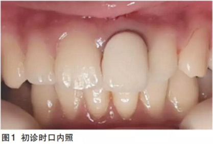 前牙即刻種植并個性化基臺美學修復 前牙即刻種植并個性化基臺美學修復