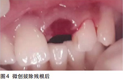 前牙即刻種植并個性化基臺美學修復 前牙即刻種植并個性化基臺美學修復