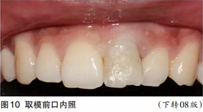 前牙即刻種植并個性化基臺美學修復 前牙即刻種植并個性化基臺美學修復