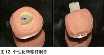 前牙即刻種植并個性化基臺美學修復 前牙即刻種植并個性化基臺美學修復