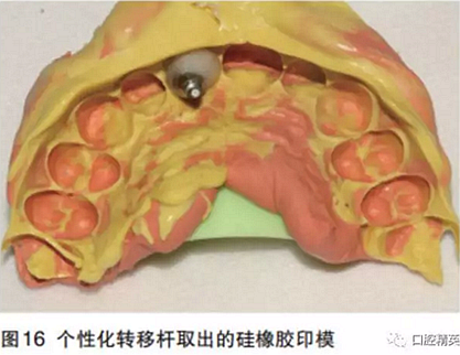 前牙即刻種植并個性化基臺美學修復 前牙即刻種植并個性化基臺美學修復