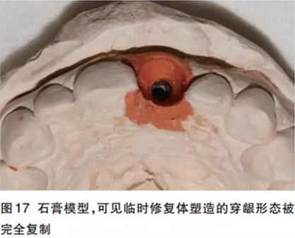 前牙即刻種植并個性化基臺美學修復 前牙即刻種植并個性化基臺美學修復