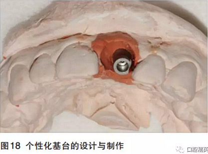 前牙即刻種植并個性化基臺美學修復 前牙即刻種植并個性化基臺美學修復