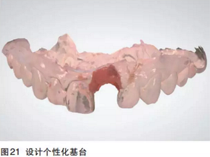 前牙即刻種植并個性化基臺美學修復 前牙即刻種植并個性化基臺美學修復