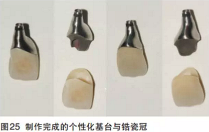 前牙即刻種植并個性化基臺美學修復 前牙即刻種植并個性化基臺美學修復