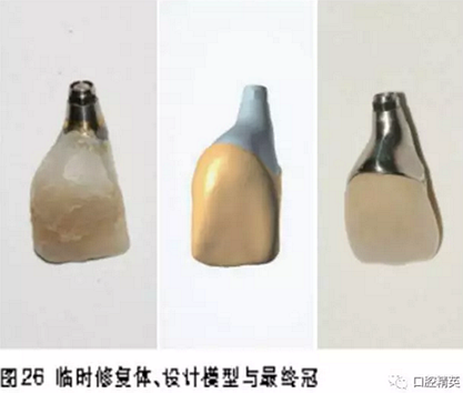 前牙即刻種植并個性化基臺美學修復 前牙即刻種植并個性化基臺美學修復